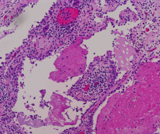 Histologic section of joint containing hyperplastic synovium, fibrin exudate, and inflammatory cell infiltrates (case 1).
