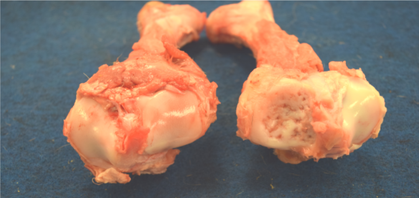 Thickened and pitted articular cartilage over right lateral tibial plateau compared to left (case 2) 