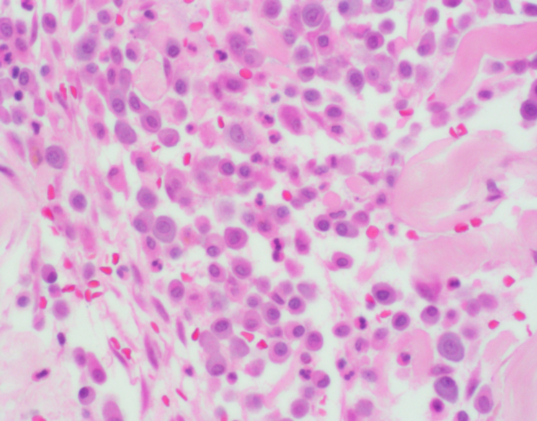 Histopathology from a low-grade canine cutaneous mast cell tumor, 600X magnification, Wright's stain. Numerous well-granulated mast cells separated by edema, moderate numbers of eosinophils and small quantities of hemorrhage. 
