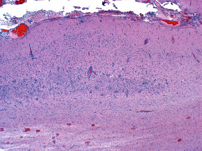 Subacute cerebral cortical laminar necrosis in a pig, 