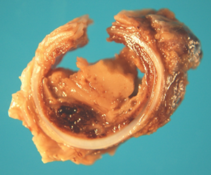 Ulceration and formation of a fibrin plug in the trachea of a pig.