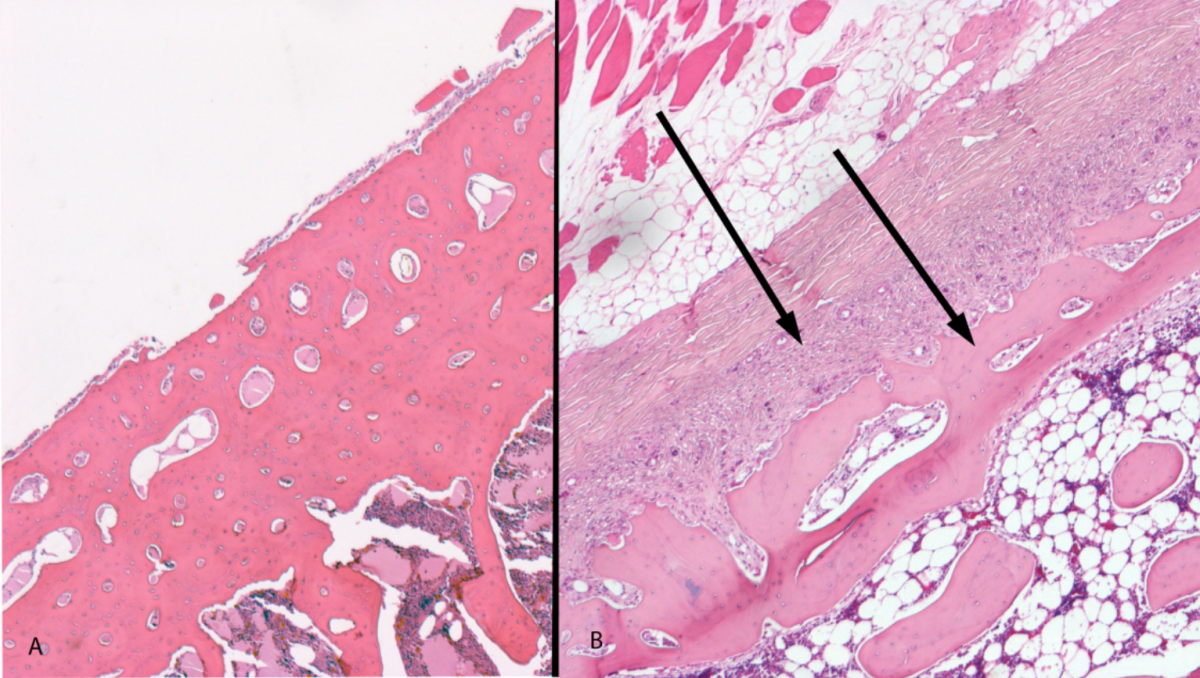Control rib (left) showing normal cortical thickness and affected rib (right) showing fibrous tissue proliferation (left arrow) surrounding a thin cortex (right arrow).