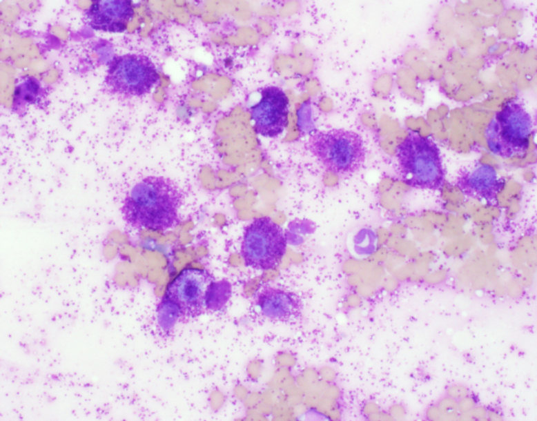 Aspiration cytology from the same low-grade canine cutaneous mast cell tumor, 600X magnification, Wright's stain. Numerous widely spaced and well-granulated mast cells, some hemorrhage, and few eosinophils. 