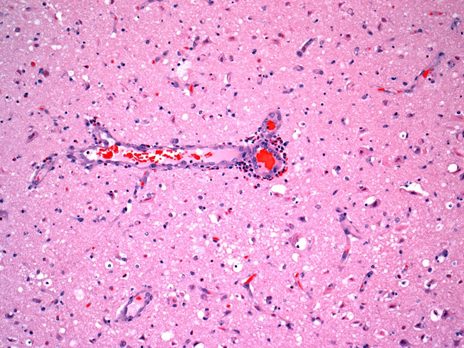 Indirect salt toxicosis; numerous eosinophils are in Virchow-Robin space around a blood vessel in cerebral cortex 