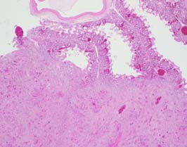 Large fungal masses occupying large areas of lung
