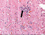 Hepatic sinusoids contain neoplastic myeloblasts.