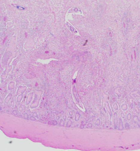 Focus of small intestinal mucosal necrosis and inflammation containing colonies of bacteria resembling Clostridium perfringens and multiple ascarid larvae. 40X H & E