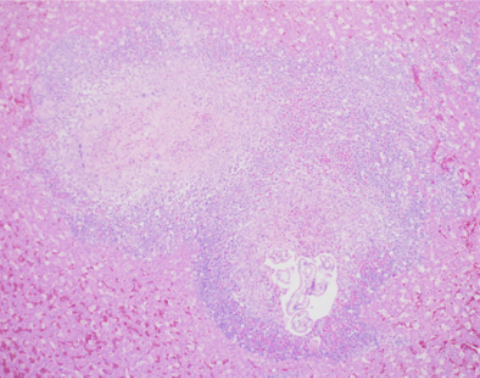 Hepatic periportal multinodular inflammation with central cores of caseous exudate and roundworm larvae surrounded by macrophages, multinucleated giant cells with an outer layer of plasma cells, lymphocytes and granulocytes. 100X H & E 