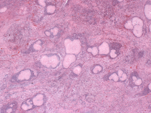 Mycetoma, hematoxylin and eosin stain. Multiple discrete foci of eosinophilic debris are surrounded by mixed inflammatory cells and fibrous stroma.