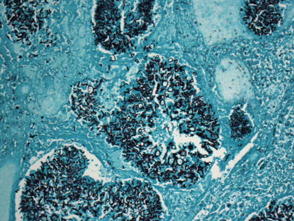 Mycetoma, methenamine silver stain. Fungal aggregates stain black, and correspond to discrete islands of eosinophilic debris in H and E-stained sections.