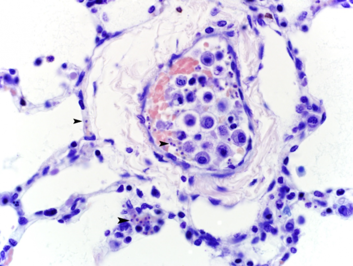   Figure 1. Lung, 600x magnification, Giemsa stain. Hypochromatic erythrocytes in blood vessels contain Giemsa-positive, roughly round, 1-2 µm diameter Babesia organisms, often in pairs (arrowheads). 