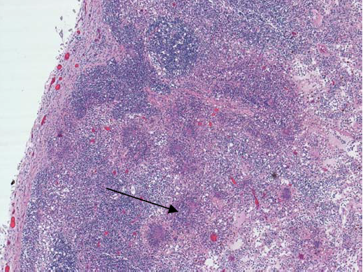  Mesenteric lymph node containing bacterial microabscesses (arrow) due to Y. pseudotuberculosis.