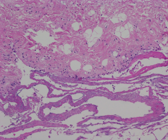 Fibrinous exudate in the right hock joint