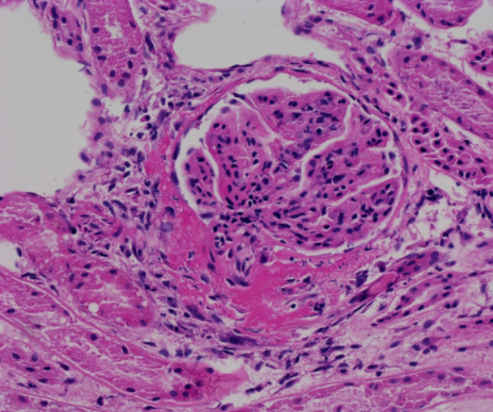 Glomerulonephritis with fibrinoid vasculitis at the hilus