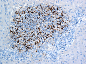 Listeria antigen (brown staining) within a focus of necrosuppurative hepatitis.  Calf with septicemic listeriosis.