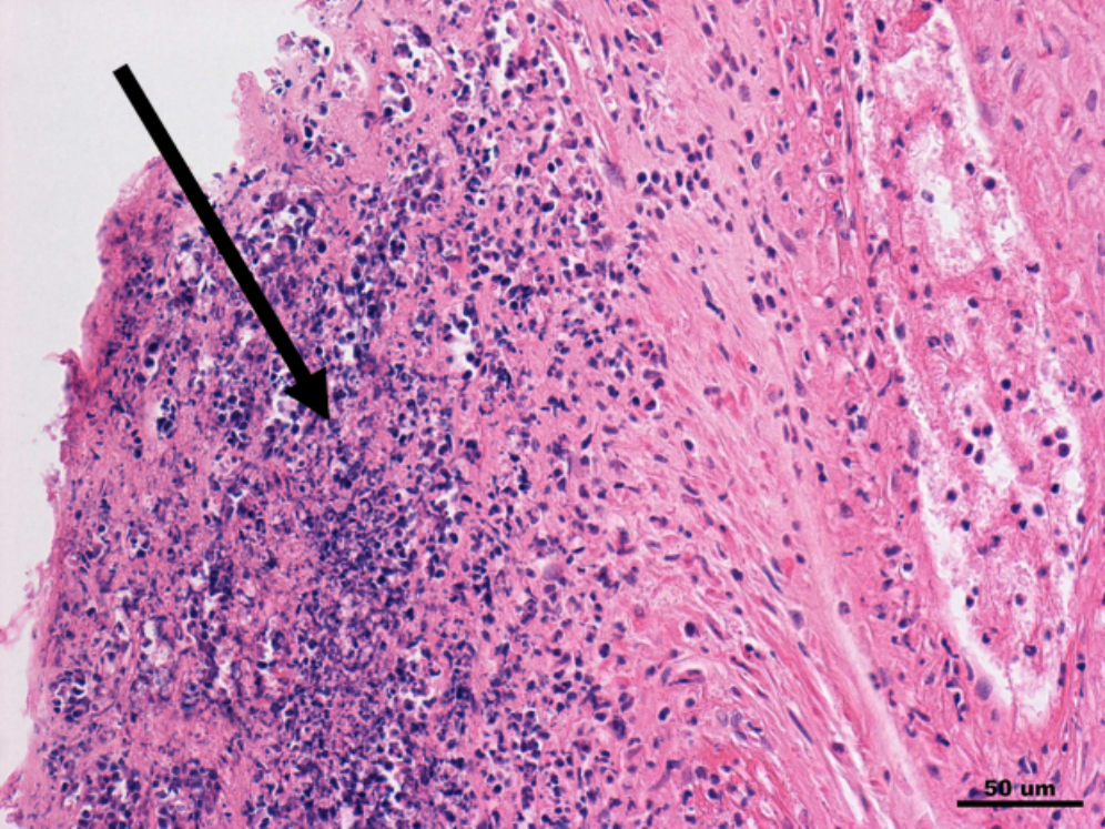 Neutrophils and fibrin over the maternal surface of the placenta (Actinomyces hyovaginalis).