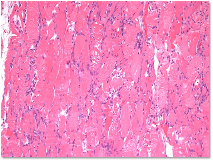 Myodegeneration in skeletal muscle of affected pig. 