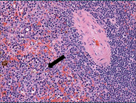 Splenic parenchyma effaced by neoplastic myeloblasts.