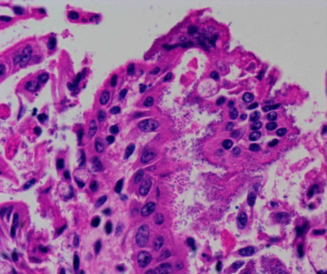   VTEC attached to surface enterocytes of the small intestine (from case 4).