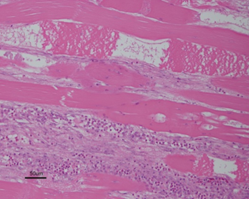 Histologic section of breast muscle showing polyphasic myodegeneration and interstitial fibrosis consistent with wooden breast (20X).