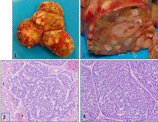 Figures 1-4. Neuroendocrine carcinoma in a bearded dragon. Figure 1, 2. Ventral surface and cut surface of liver. Figures 3, 4. Hepatic nodule. Gastric mass. H&E. 20X.