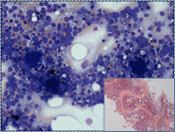  Very cellular bone marrow core biopsy.