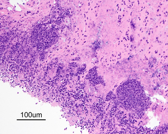 Autolysed chorioallantois infiltrated by neutrophils