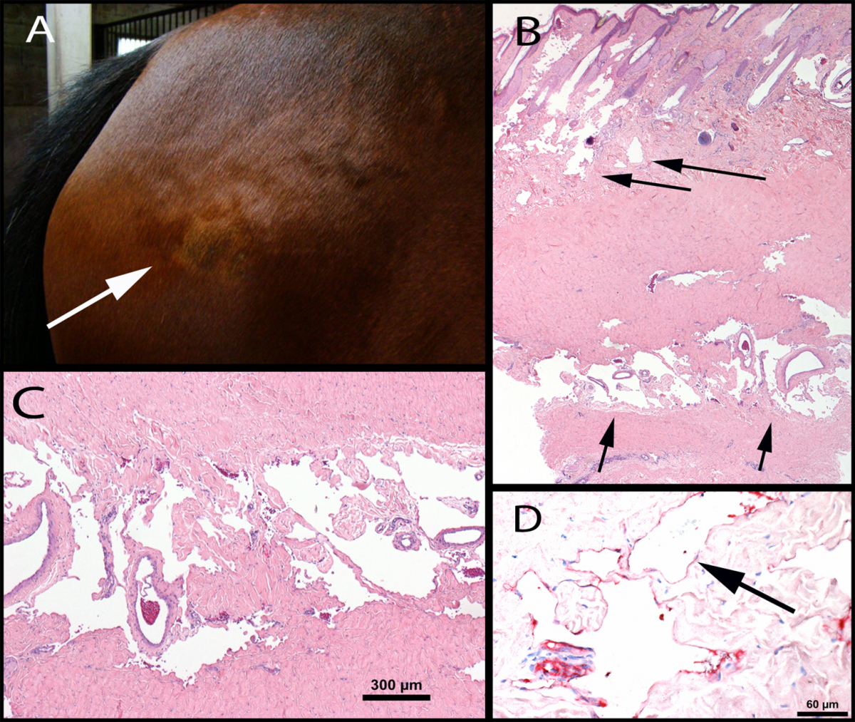 A. Gross photograph of the lesion – lumpy area on the hip region (arrow). B. Full-thickness biopsy showing vessels in the superficial and deep areas of the vessel (arrows). C. Close view of vessels in the deep layers of the biopsy. D. Factor VIII IHC stain shows red staining of cells lining the vessels compatible with vascular or lymphatic endothelium.