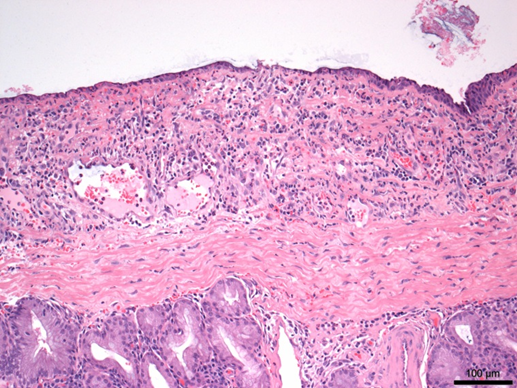 erosive tracheitis