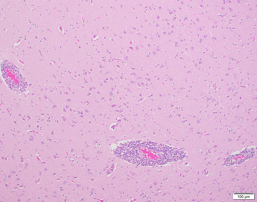 Non-suppurative perivascular cuffing in bovine brain in a case of astrovirus-associated encephalitis 