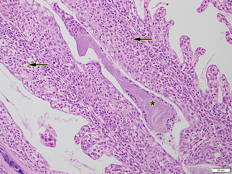 Figure 2. Histology of gills with widespread lamellar epithelial hyperplasia with fusion (arrow) and dense filamentous bacteria (asterisks).