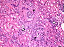 Chronic glomerulitis with epithelialization