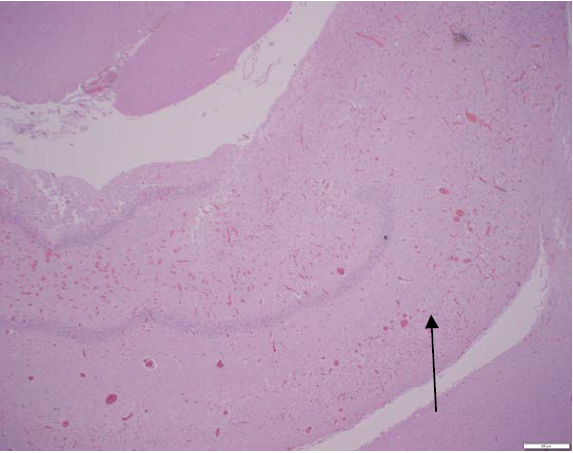 Figure 1. Hippocampus, showing loss of pyramidal cell layer (arrow) and neovascularization. H&E.