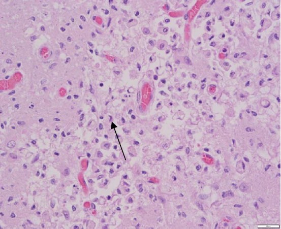 Figure 2. Hippocampus, showing necrosis, gliosis, and infiltrating gitter cells (arrow). H&E.