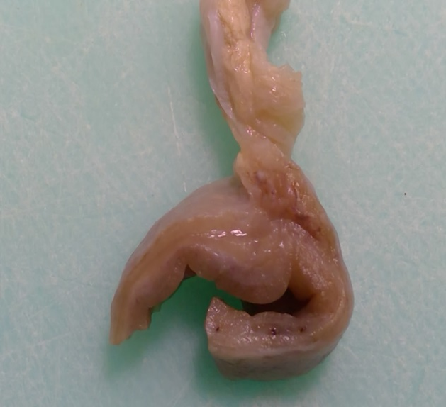 Section through formalin-fixed jejunum showing segmental transmural thickening.