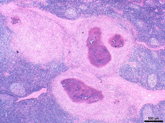 Mandibular lymph node, market hog. Normal node architecture is replaced and effaced by caseous granulomas. H&E stain, 200x.