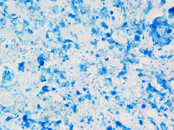 Mandibular lymph node, market hog. A few acid-fast bacilli (circled) among central debris in caseous granuloma. Ziehl-Neelsen acid-fast stain, 1000x.