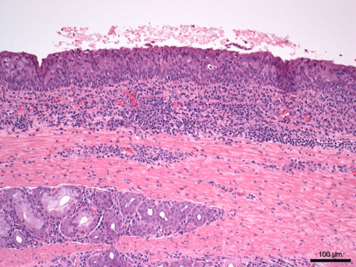 mild tracheitis