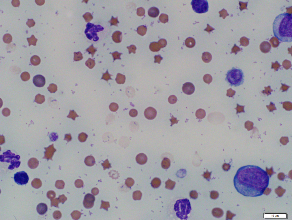 Mycoplasma haemofelis infection. Note marked anemia, RBC ghosts (intravascular hemolysis), abundant epicellular coccoid-to-signet-ring shaped organisms at the periphery of the RBCs and free in the slide background.