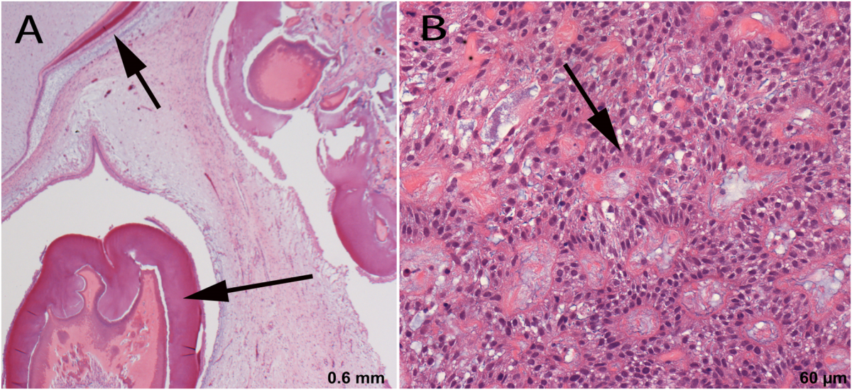 Figure1A compound odontoma, figure 1B ameloblastoma