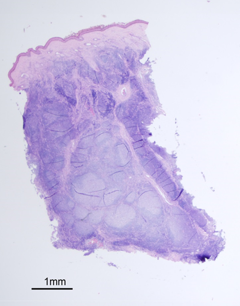 Figure 2. Histology of skin lesion.