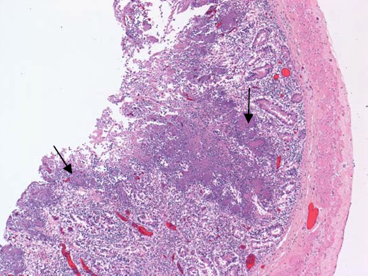  Small intestine revealing mucosal erosion and multiple colonies of Y. pseudotuberculosis (arrows).