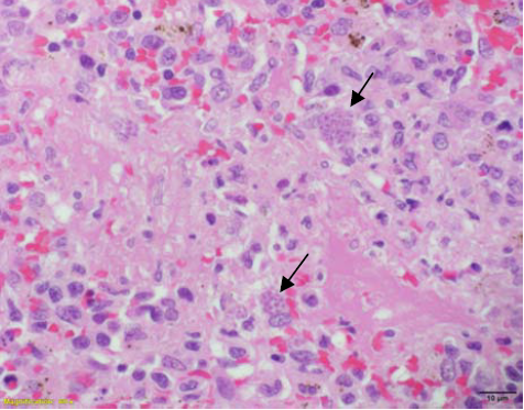 Figure 1. A focus of acute fibrinous splenic necrosis with a few variably sized clusters (arrows) of Toxoplasma gondii tachyzoites at the outer margin. 600X H&E 