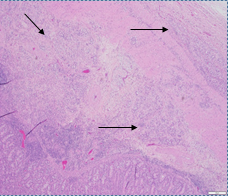 Histologic section through stenotic jejunal segment, arrows showing tumor infiltrates (mucosa at bottom of photo).