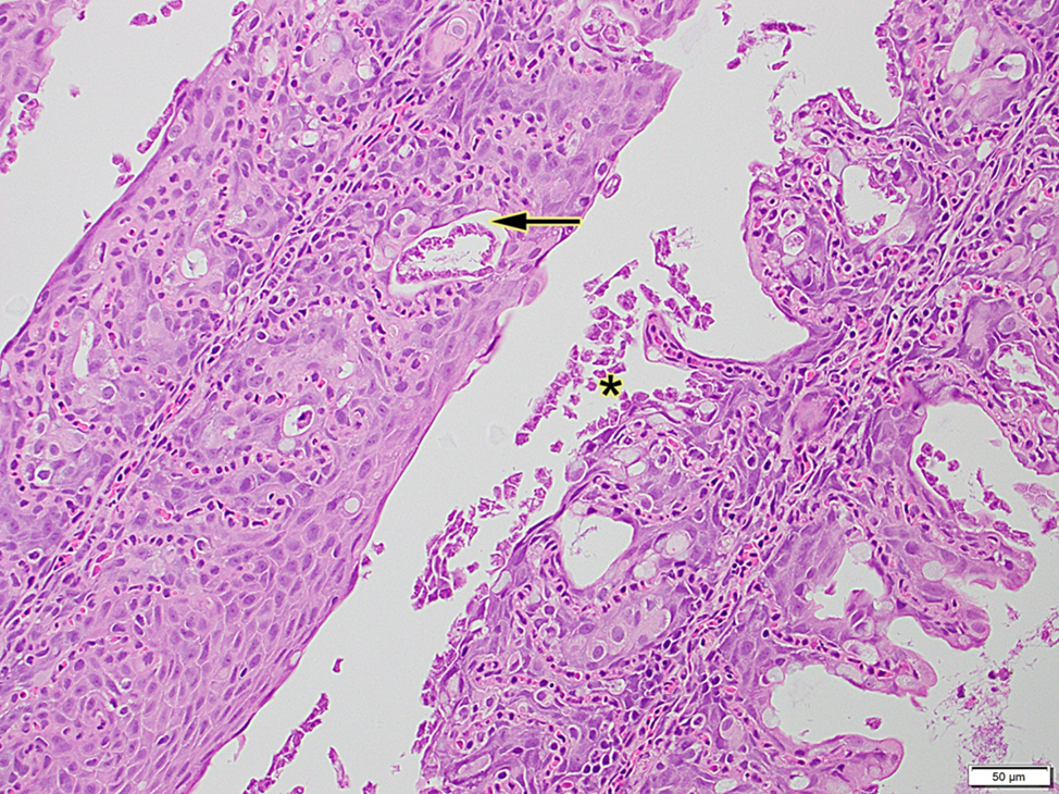 Figure 3. Histology of gills with widespread lamellar epithelial hyperplasia, fusion, and pocket formation (arrow) with interspersed amoebic trophozoites (asterisks).