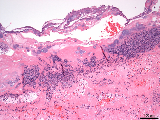 ulcerative tracheitis