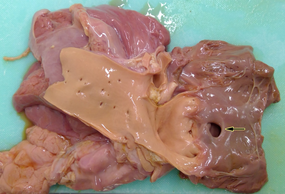 Heart with high ventricular septal defect (arrow).