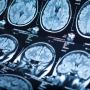 A brain scan