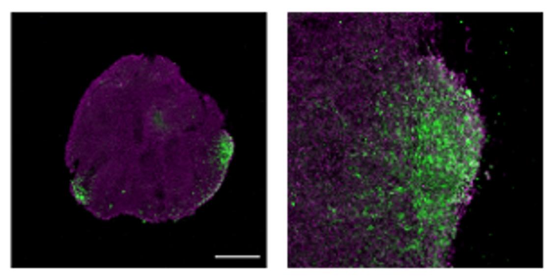 Left: Human breast cancer cells (green) attached to and infiltrating a human stem cell-derived brain organoid (magenta). Right: High magnification of left panel. Images courtesy of Dr. Begüm Alural.