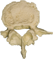 A photograph of the L5 Lumbar Vertebrae.